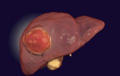 肝癌早期症状有哪些？肿瘤专家提醒：这7个症状要警惕，及时发现及时控制病情