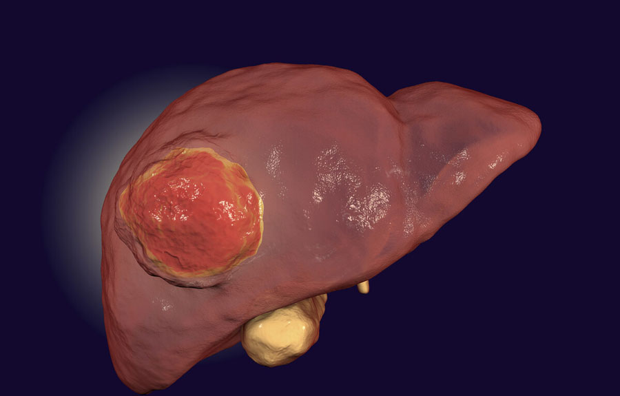 肝癌早期症状有哪些?肿瘤专家提醒:这7个症状要警惕,及时发现及时控制病情
